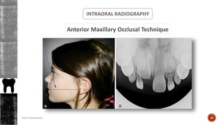 INTRAORAL RADIOGRAPHY
Anterior Maxillary Occlusal Technique
49Arwa Namnakani
 