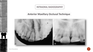 INTRAORAL RADIOGRAPHY
Anterior Maxillary Occlusal Technique
50Arwa Namnakani
 