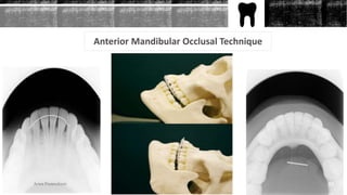 Anterior Mandibular Occlusal Technique
53Arwa Namnakani
 