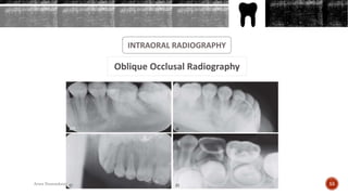 INTRAORAL RADIOGRAPHY
Oblique Occlusal Radiography
55Arwa Namnakani
 