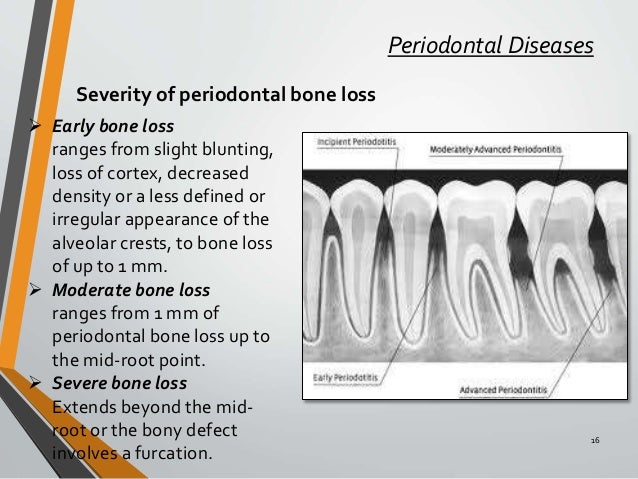 Radiographic aids in dx of periodontol ds part b