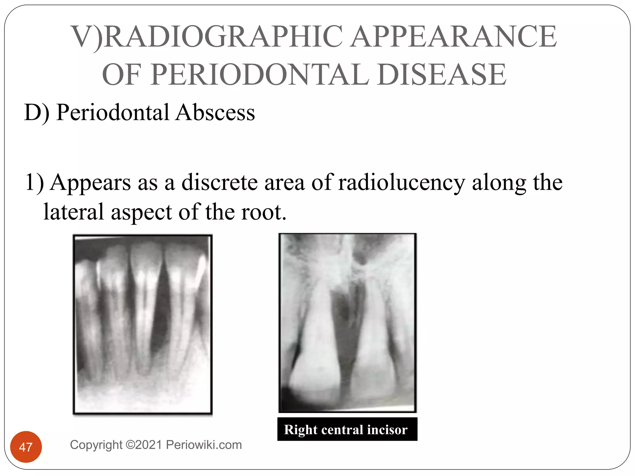 Radiographic aids in periodontal disease diagnosis part I | PPTX