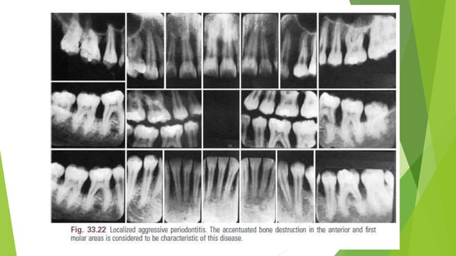 Periodontal Radiographs Radiographic Aids in the Diagnosis of Periodontal Diseases.pptx