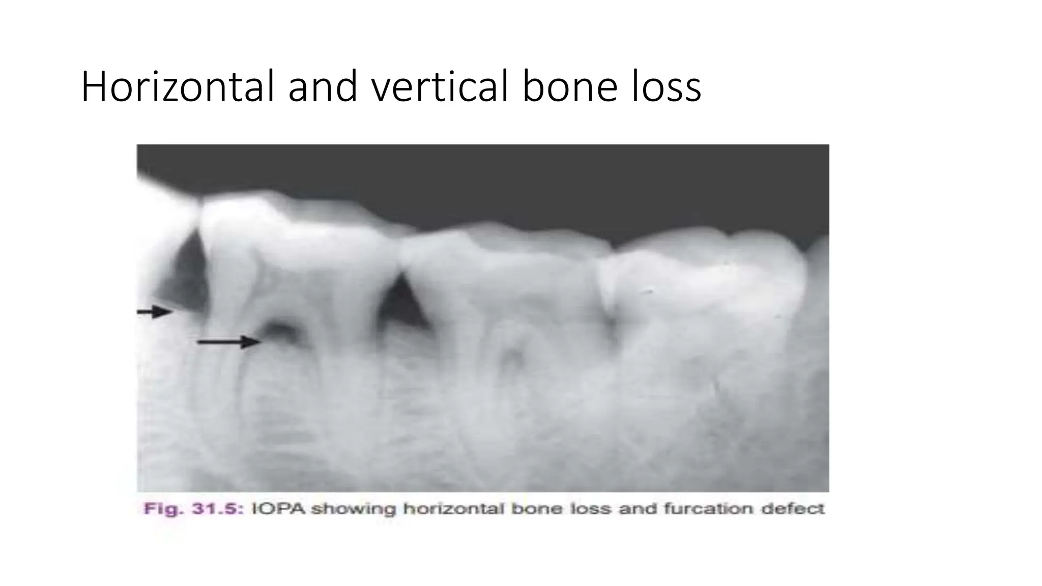 Vertical Radiograph RADIOGRAPHIC AIDS IN THE DIAGNOSIS OF PERIODONTAL DISEASES.pptx