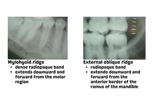 Oblique Ridge Radiography DENTAL RADIOGRAPHIC ANATOMICAL LANDMARKS .pdf
