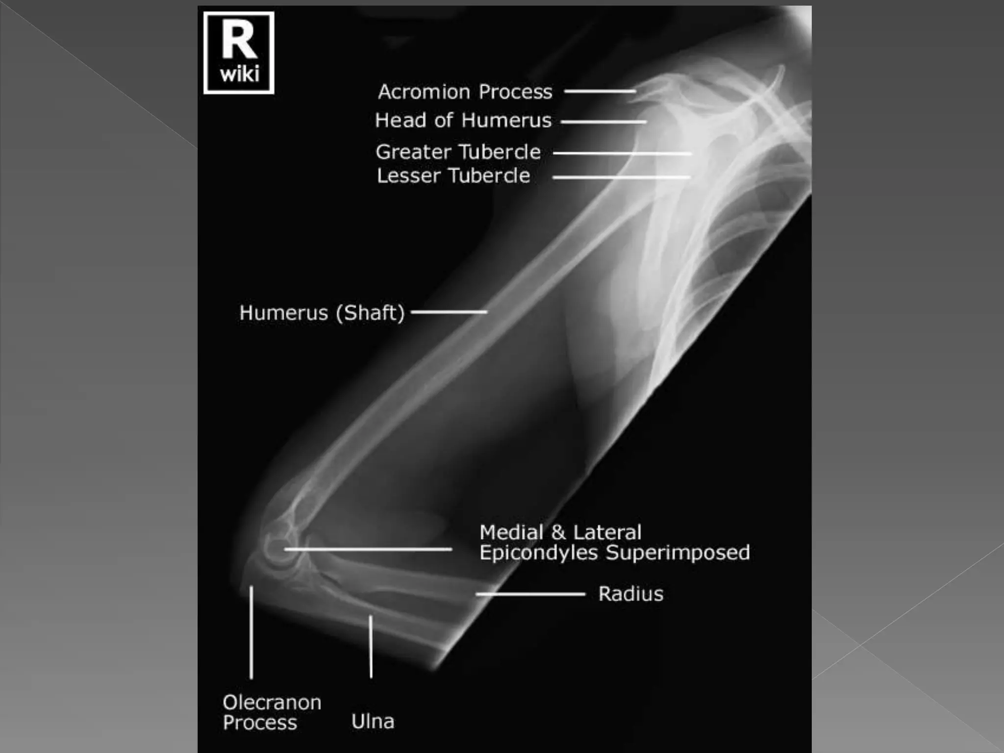 Radiographic anatomy of upper limb | PPTX