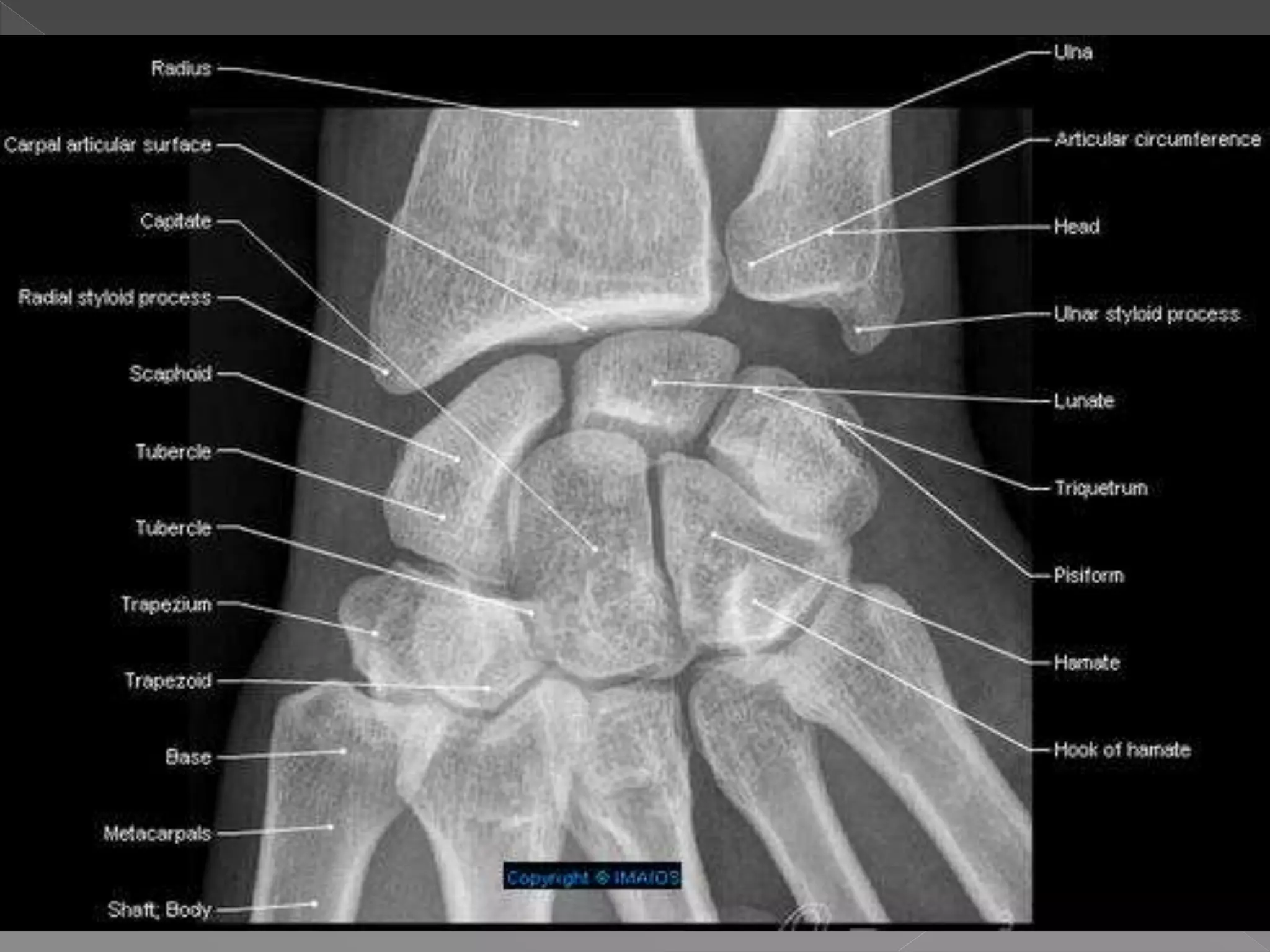 Radiographic anatomy of upper limb | PPTX