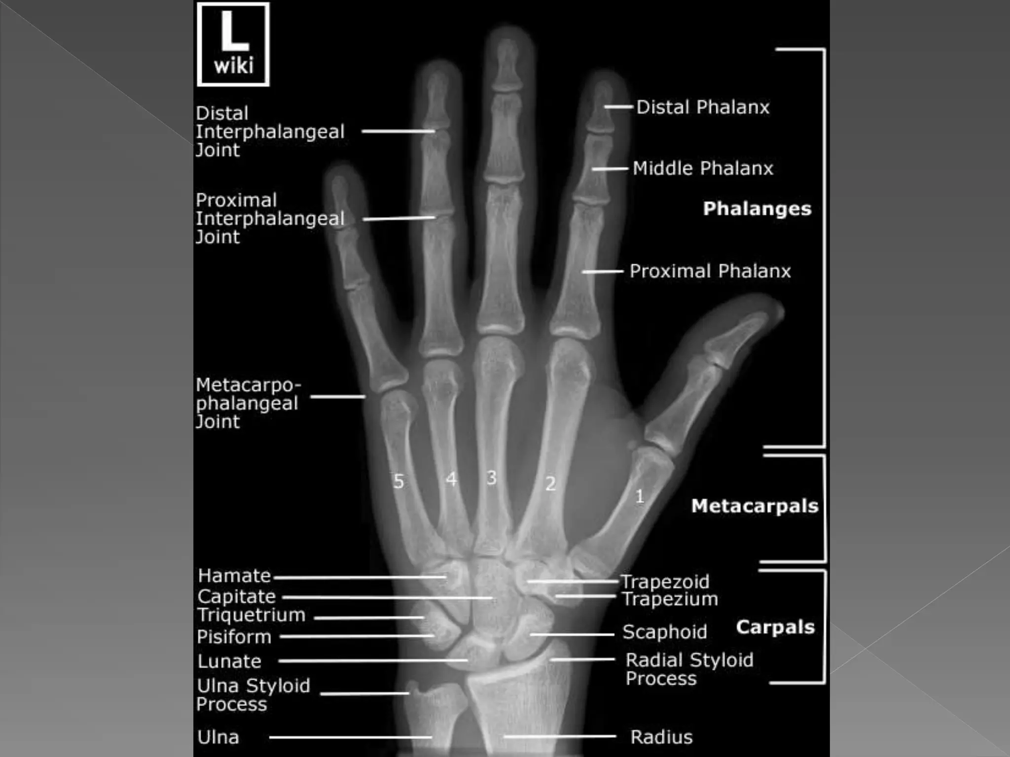 Radiographic anatomy of upper limb | PPTX