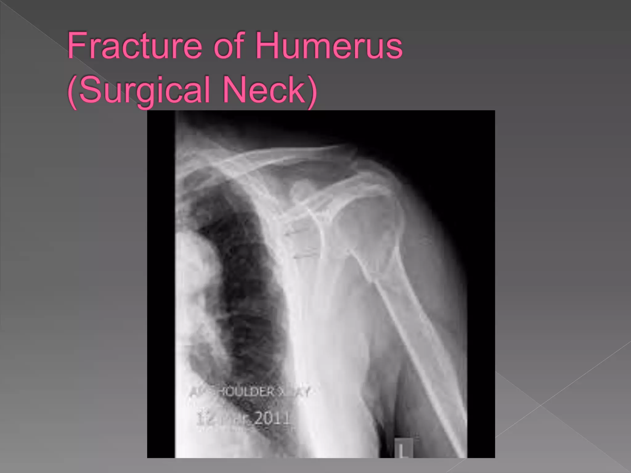 Radiographic anatomy of upper limb | PPTX