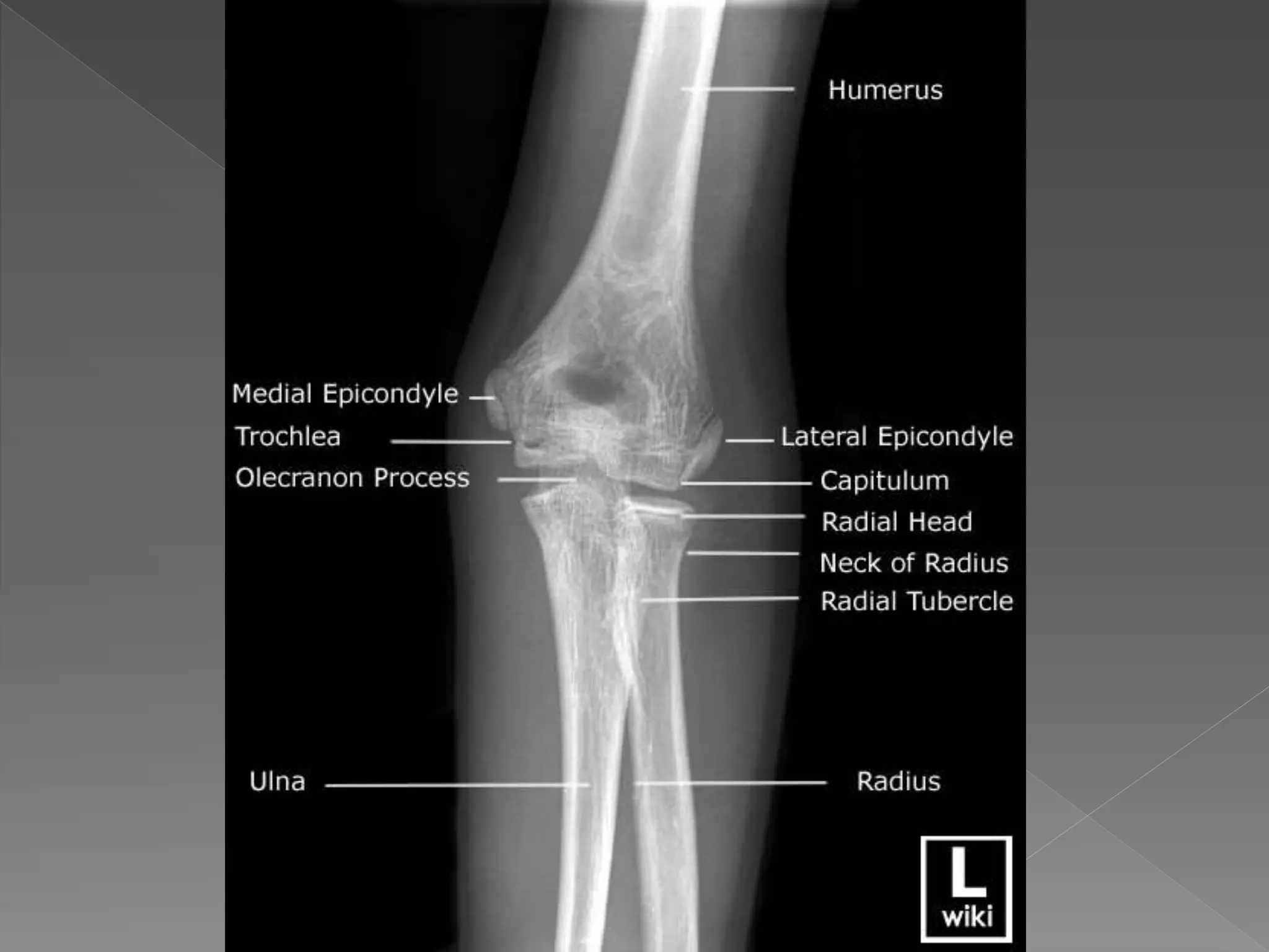 Radiographic anatomy of upper limb | PPTX