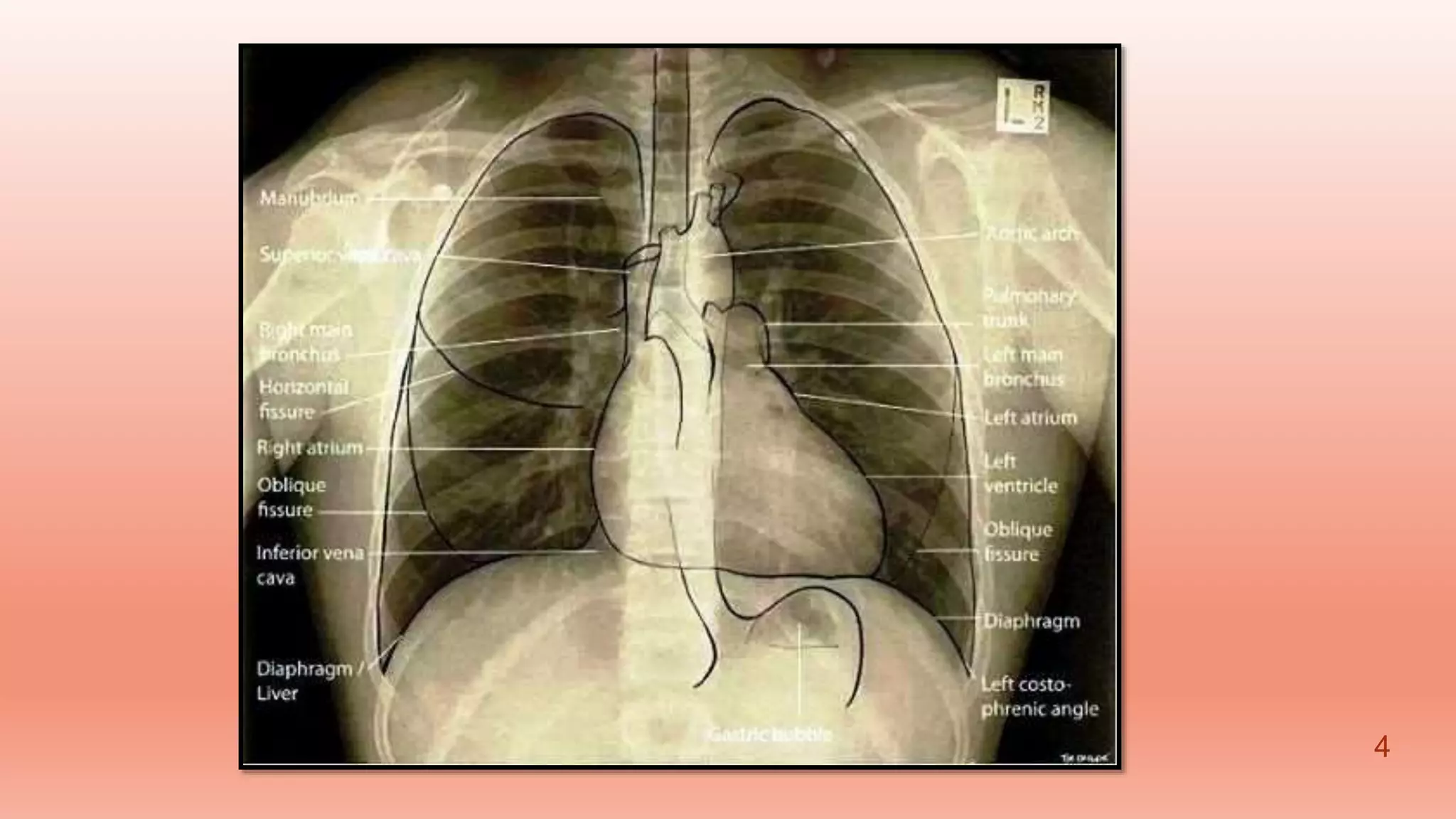 Radiographic anatomy | PPTX