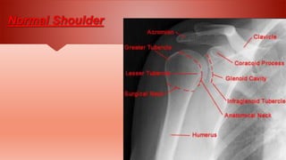 Normal Variations Radiology Shoulder Radiographic anatomy | PPTX