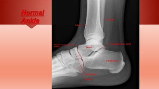 Angulo Tobillo Radiographic anatomy | PPTX