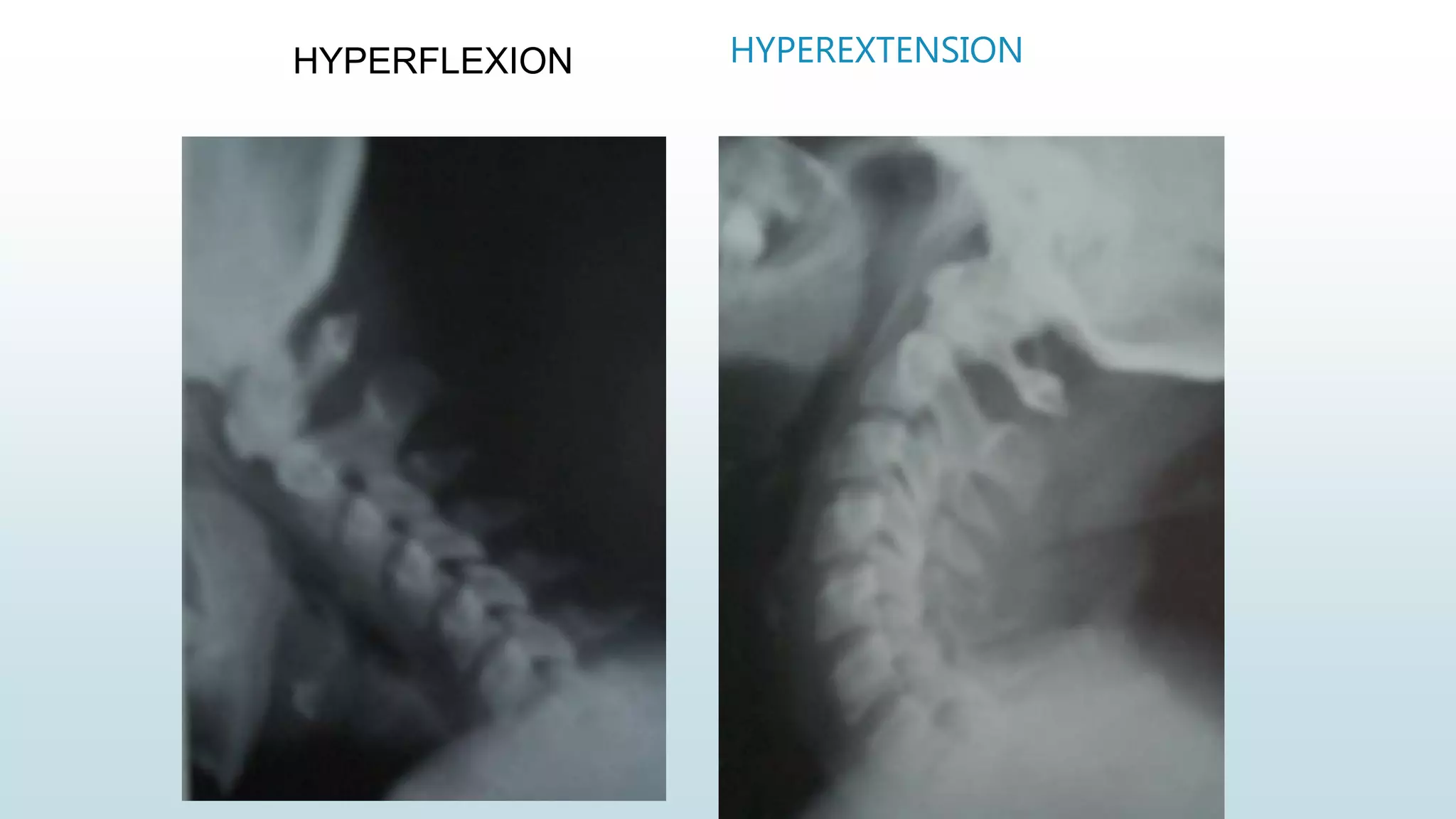 Radiographic anatomy and views of c spine | PPTX
