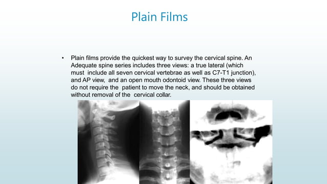 Cd Spine Example Radiographic anatomy and views of c spine | PPTX | Death, Injury, or ...
