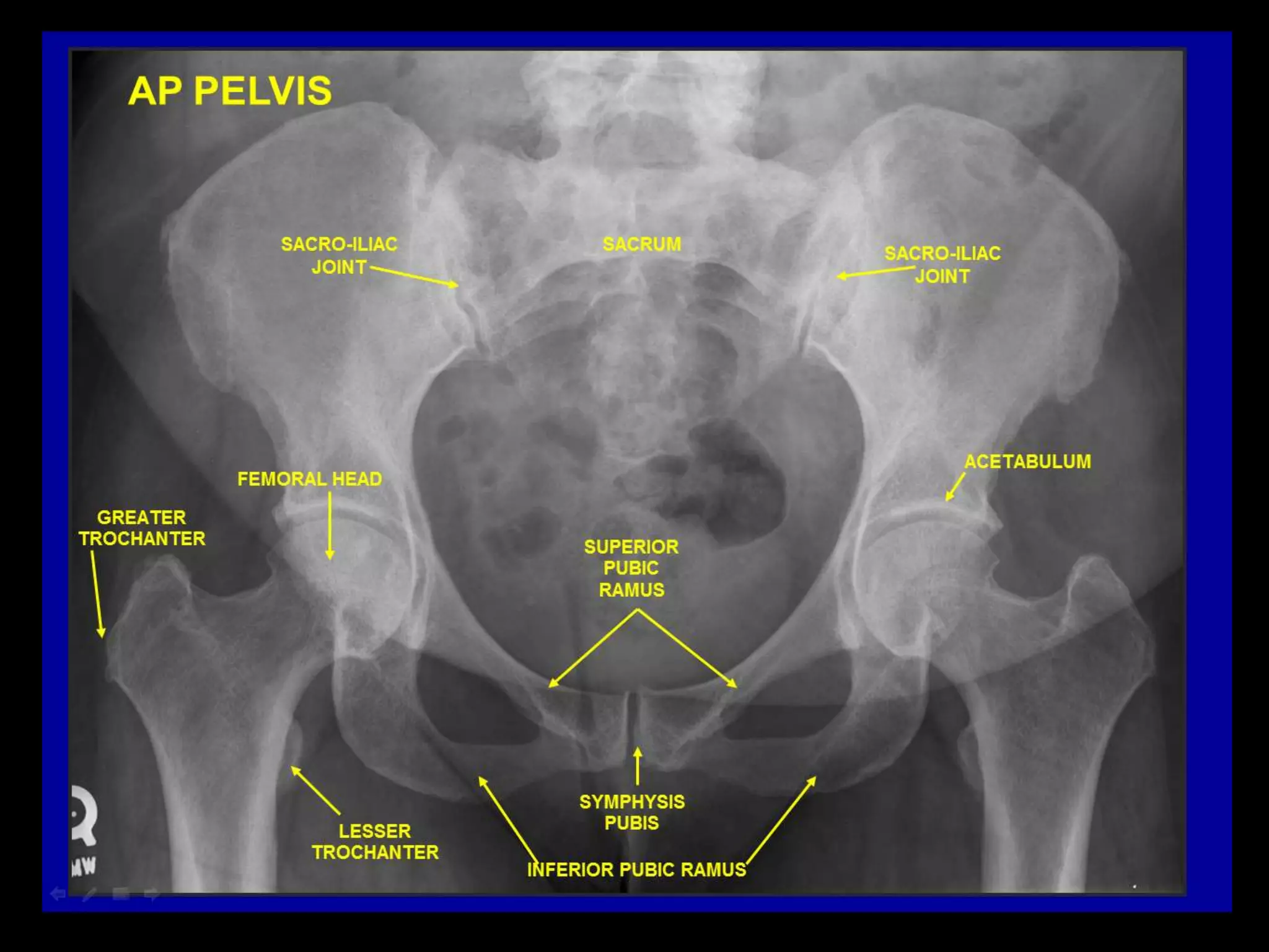 Hip Radiograph Radiopaedia Radiographic anatomy of abd and pelvis r a | PPTX