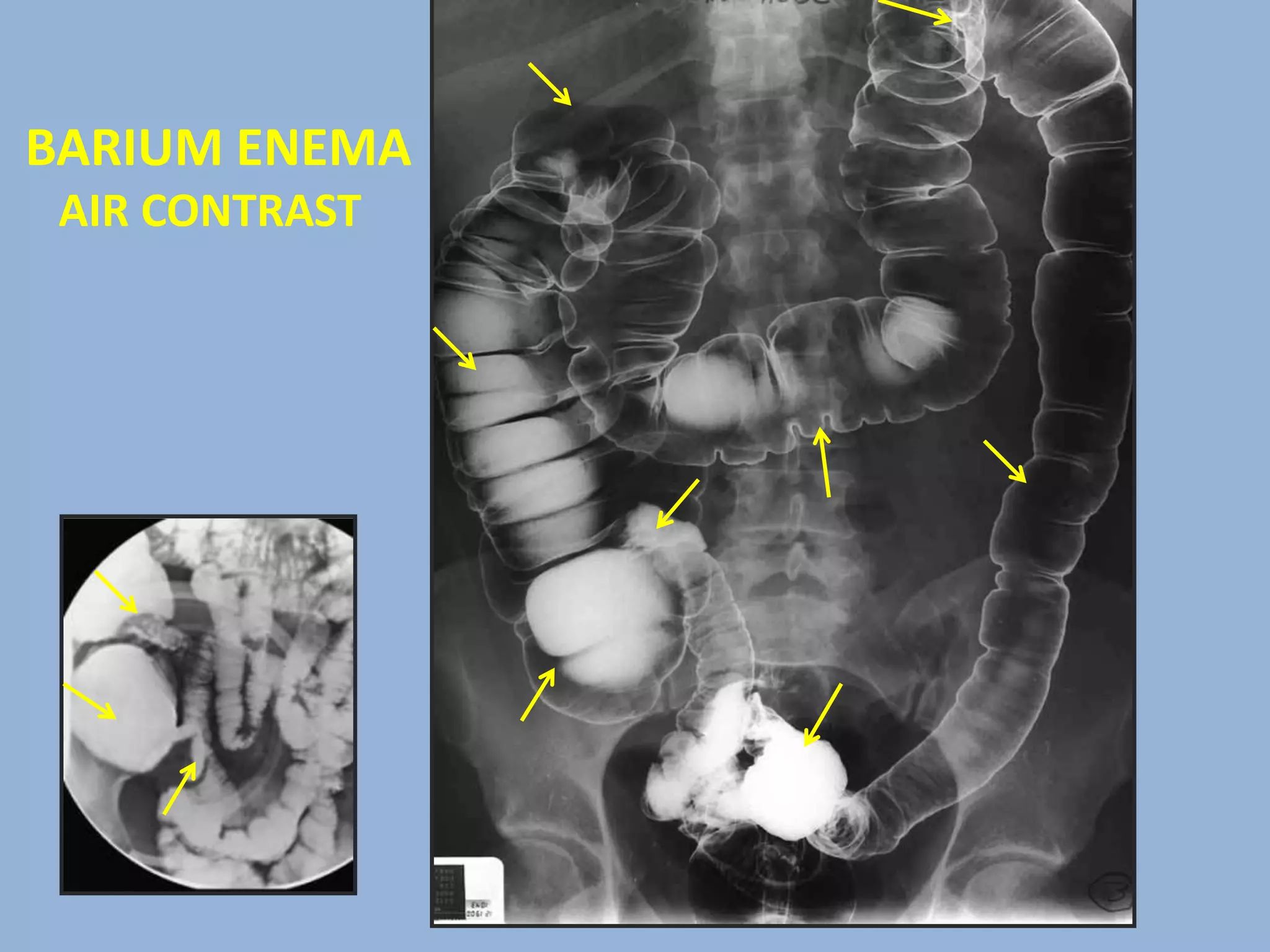 Radiographic anatomy of abd and pelvis r a | PPTX