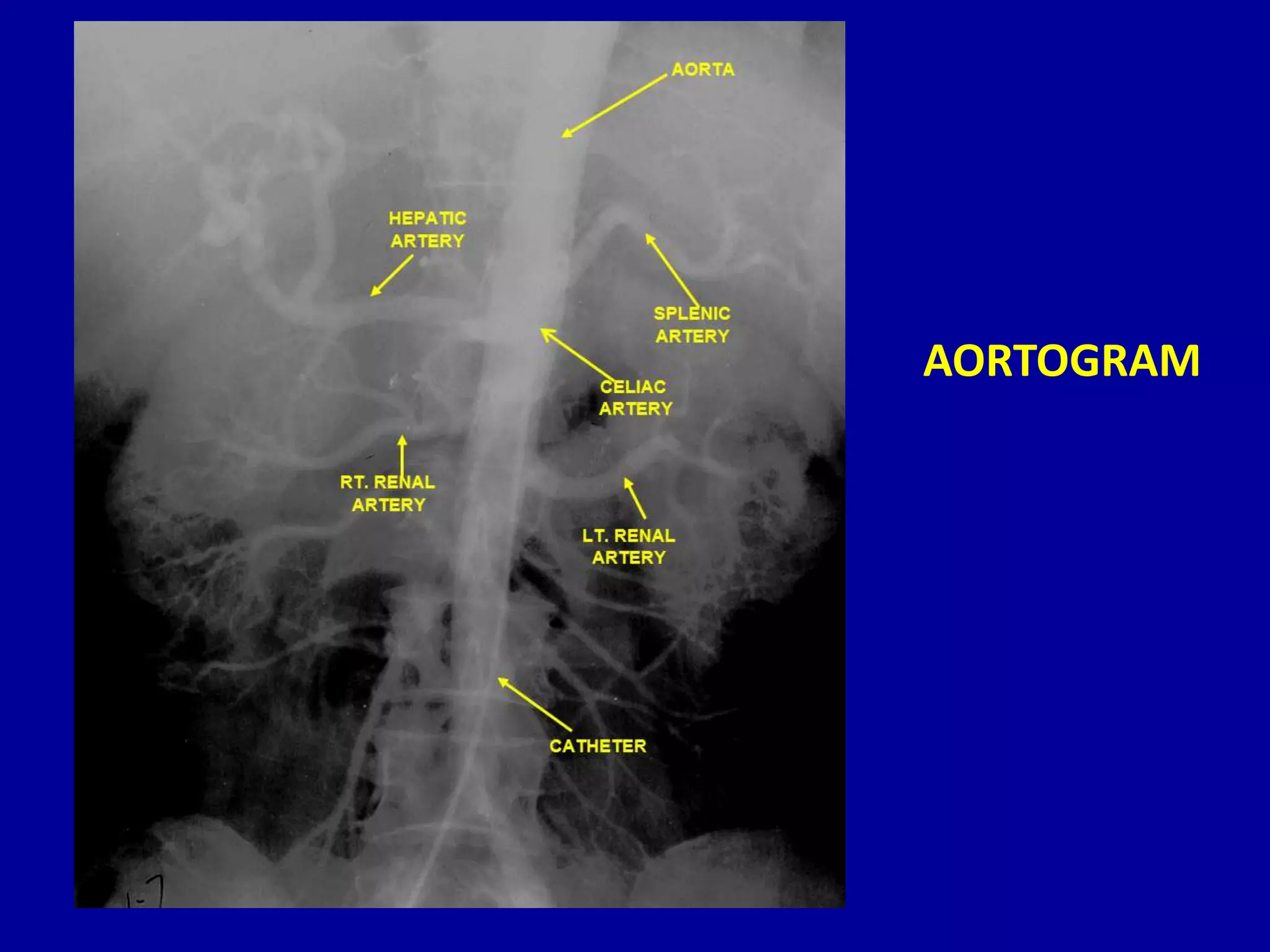 Radiographic anatomy of abd and pelvis r a | PPTX