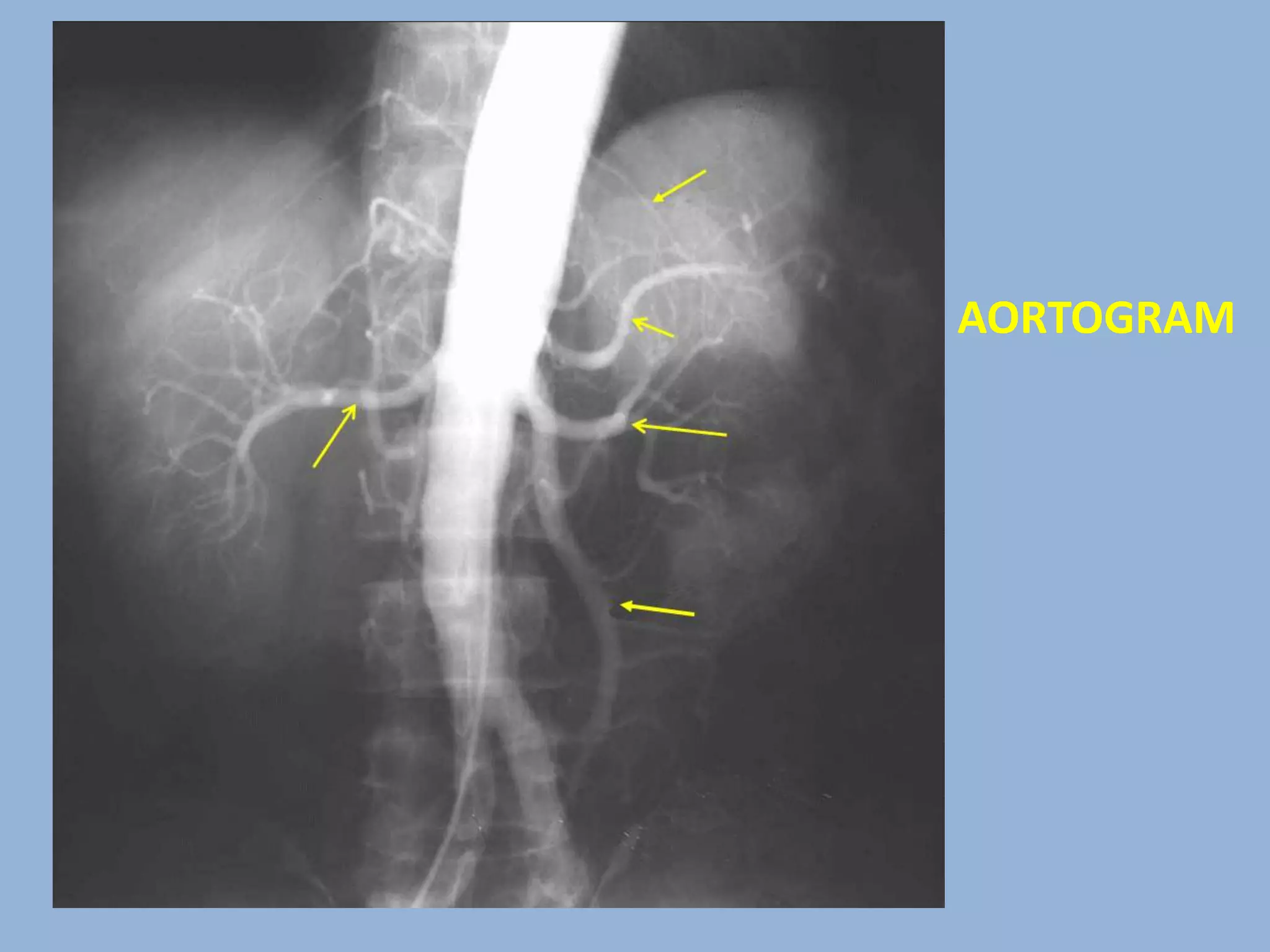 Radiographic anatomy of abd and pelvis r a | PPTX