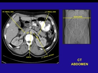 Radiographic anatomy of abd and pelvis r a | PPTX