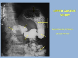 Hampton Line Radiographic anatomy of abd and pelvis r a | PPTX