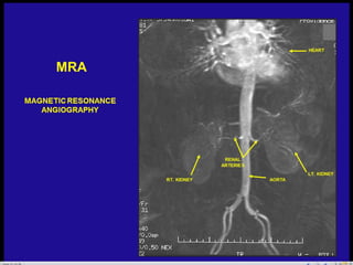 Radiographic anatomy of abd and pelvis r a | PPTX