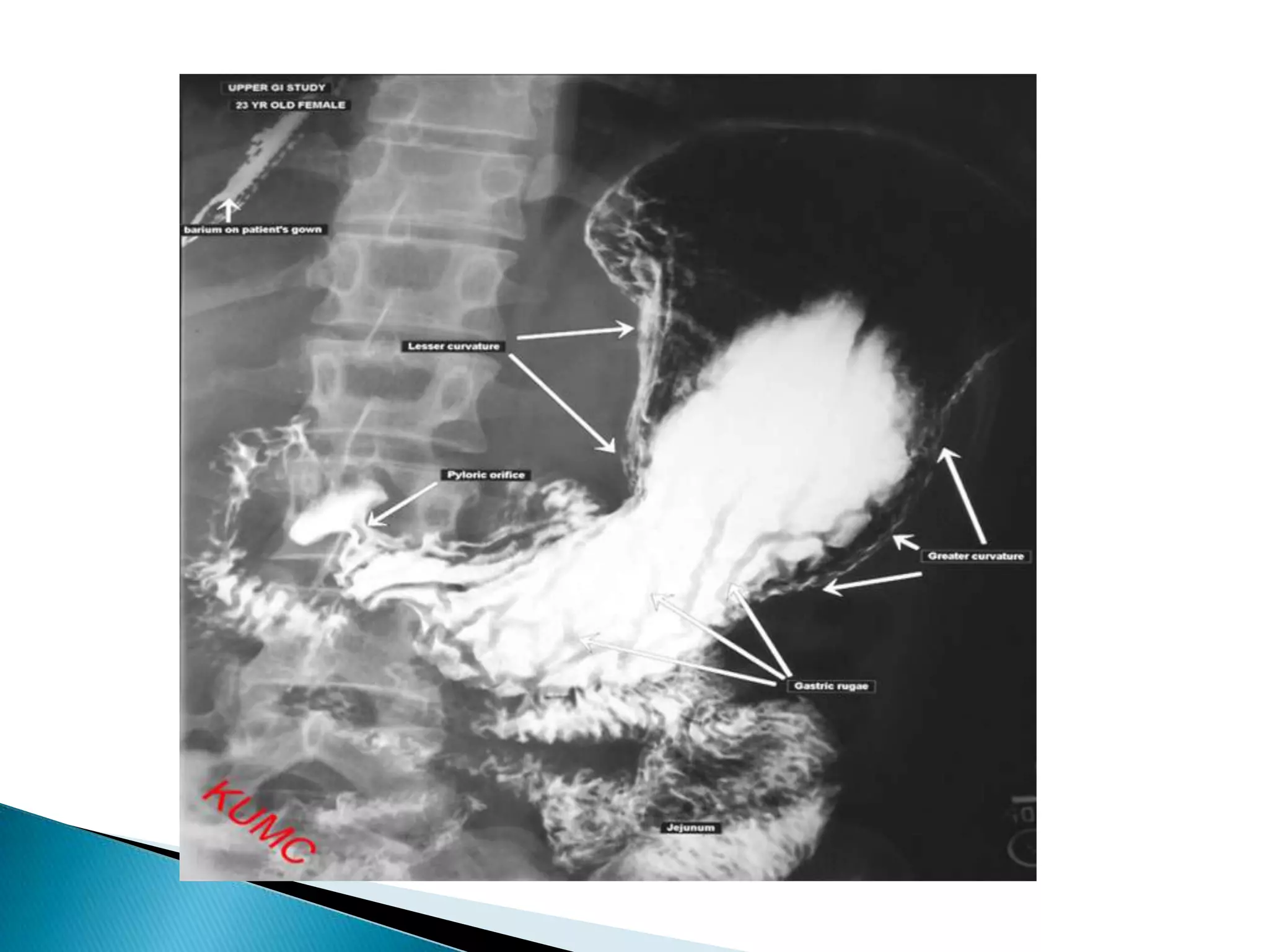 Radiographic anatomy of gastrointestinal tract | PPTX
