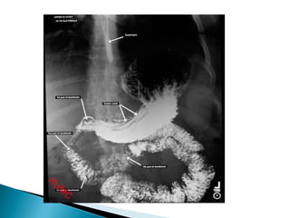 Radiographic anatomy of gastrointestinal tract | PPTX