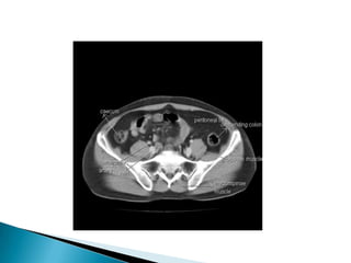 Radiographic anatomy of gastrointestinal tract | PPTX