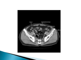 Radiographic anatomy of gastrointestinal tract | PPTX