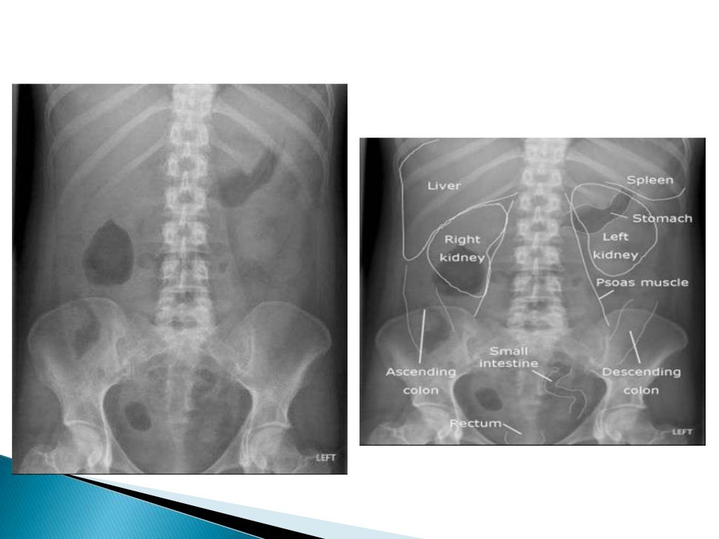 Radiographic anatomy of gastrointestinal tract