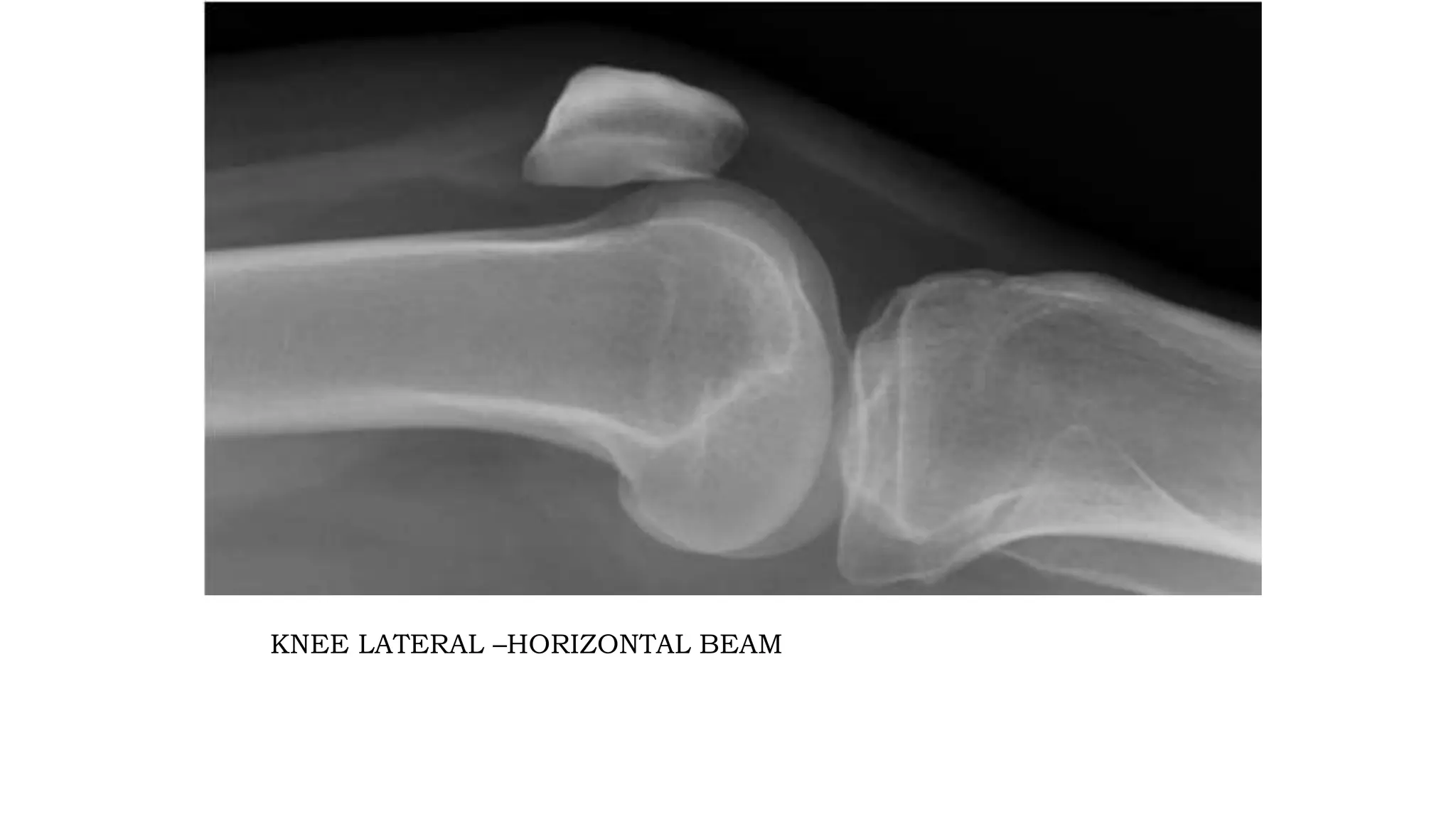 RADIOGRAPHIC ANATOMY OF KNEE JOINT AND ITS RADIOGRAPHIC VIEWS.pptx