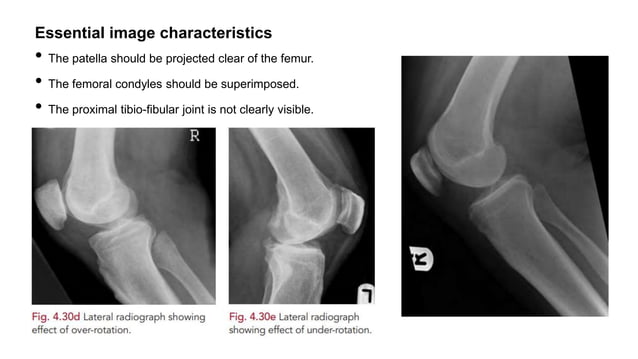 RADIOGRAPHIC ANATOMY OF KNEE JOINT AND ITS RADIOGRAPHIC VIEWS.pptx ...