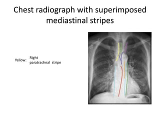 Radiographic anatomy of lungs.pptx