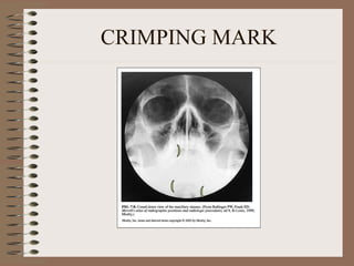 CRIMPING MARK 