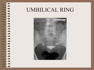 UMBILICAL RING 
