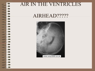 AIR IN THE VENTRICLES AIRHEAD????? 