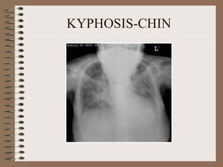 KYPHOSIS-CHIN 