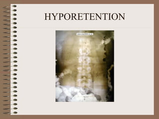 HYPORETENTION 