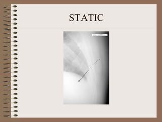 Radioactive Static Radiographic artifacts 2 | PPT