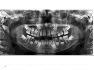Radiographic assessment in paediatric dentistry | PPTX