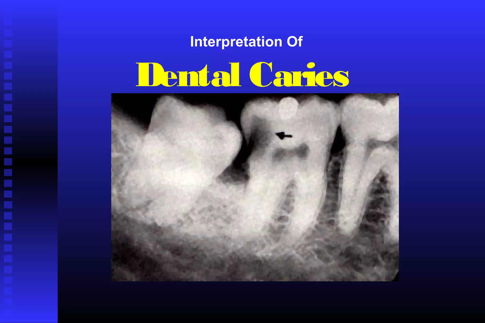 Radiographic assessment of dental caries | PPT