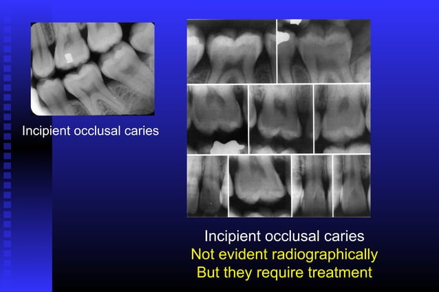 Radiographic assessment of dental caries | PPT