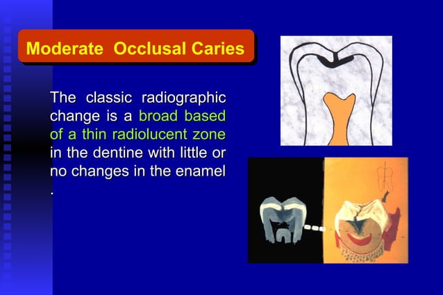 Radiographic assessment of dental caries | PPT