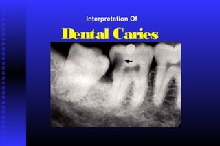 Interpretation Of
Dental Caries
 