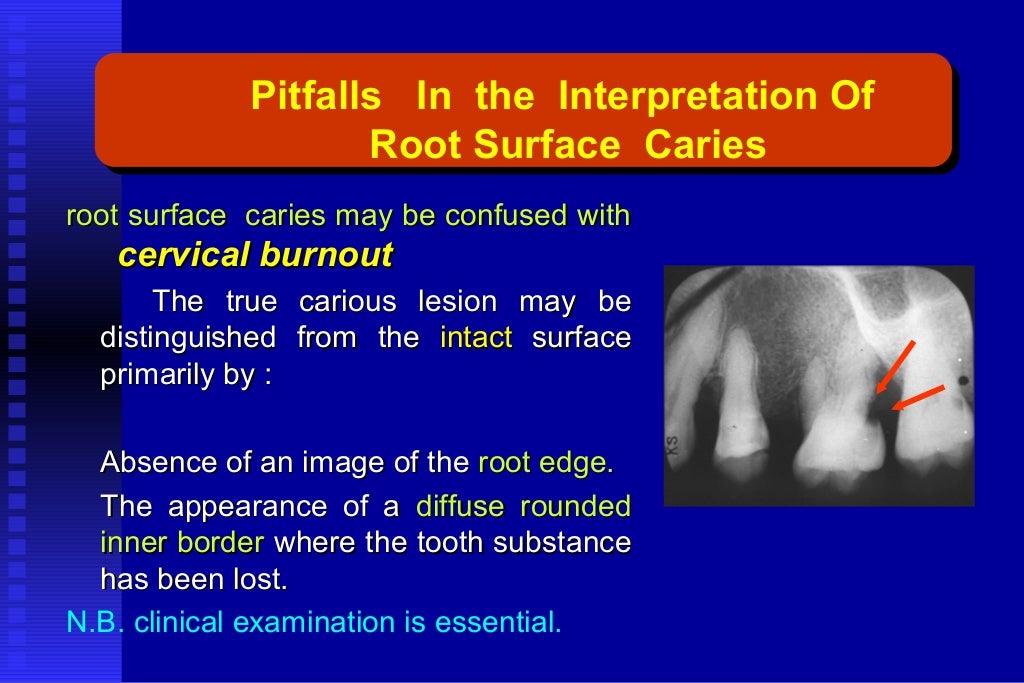 Radiographic assessment of dental caries