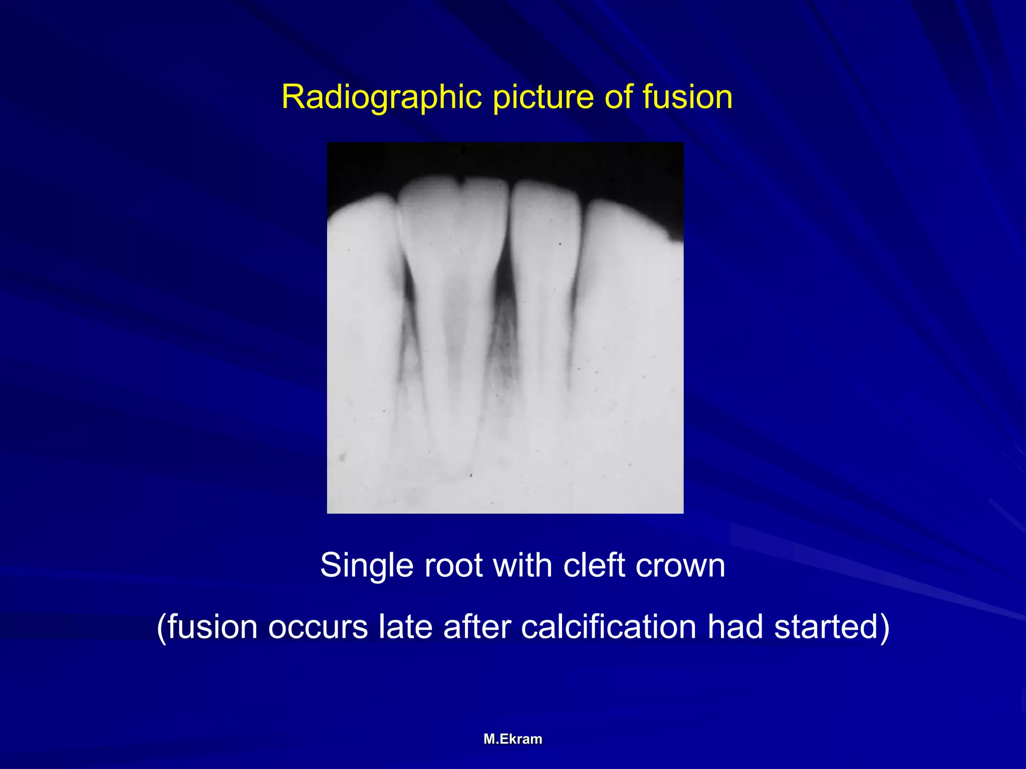 Radiographic assessment of teeth developmental anomalies | PPT
