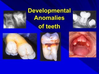 Developmental
Anomalies
of teeth
 