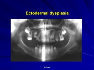 Ectodermal Defect Radiographic assessment of teeth developmental anomalies | PPT