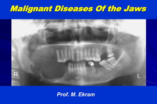 M.Ekram
Malignant Diseases Of the Jaws
Prof. M. Ekram
 